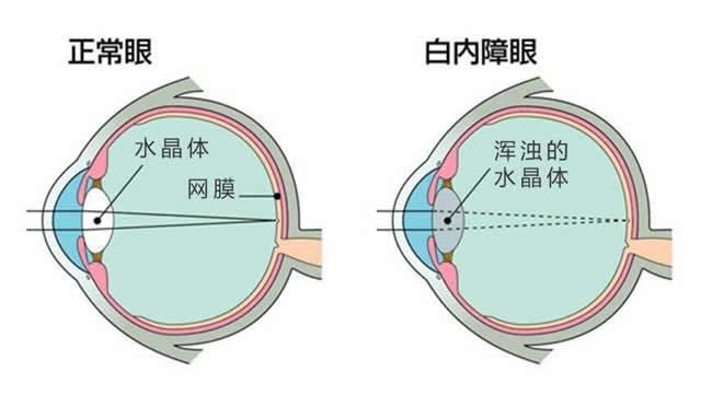 白内障患者与正常眼睛的区别