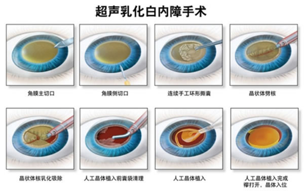 白内障超声乳化手术治疗过程